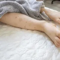 view of sleeping childs legs full of insect bites